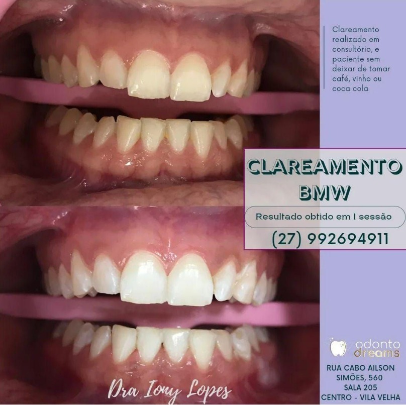 AVALIACAO LIMPEZA E CLAREAMENTO DENTAL BMW